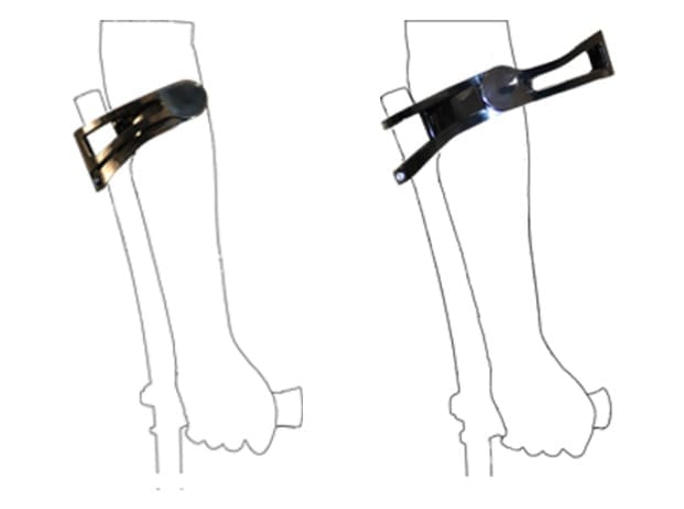 Line drawing of a forearm with the INDESmed cuff closed on the left and open on the right
